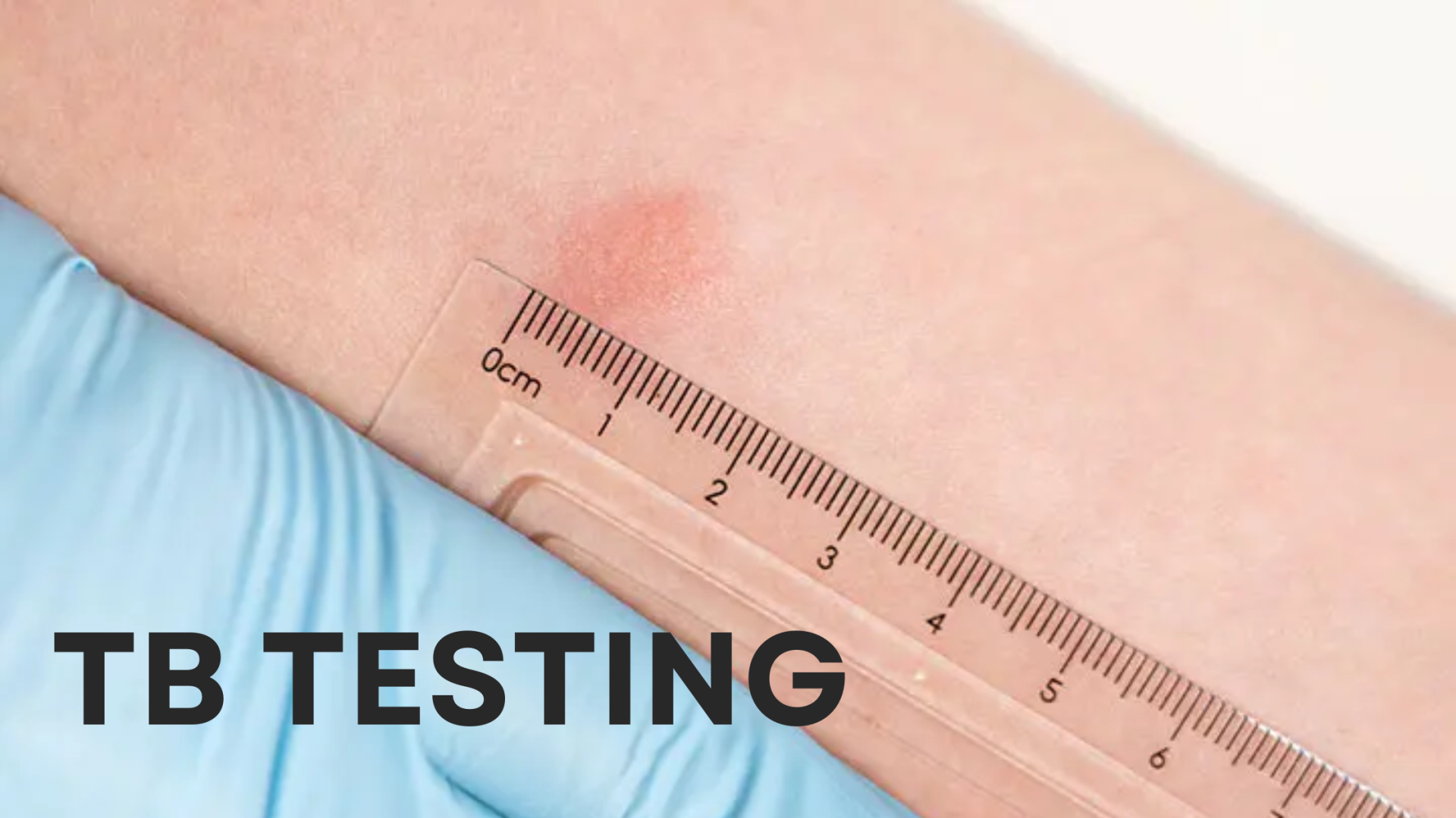 tb test
